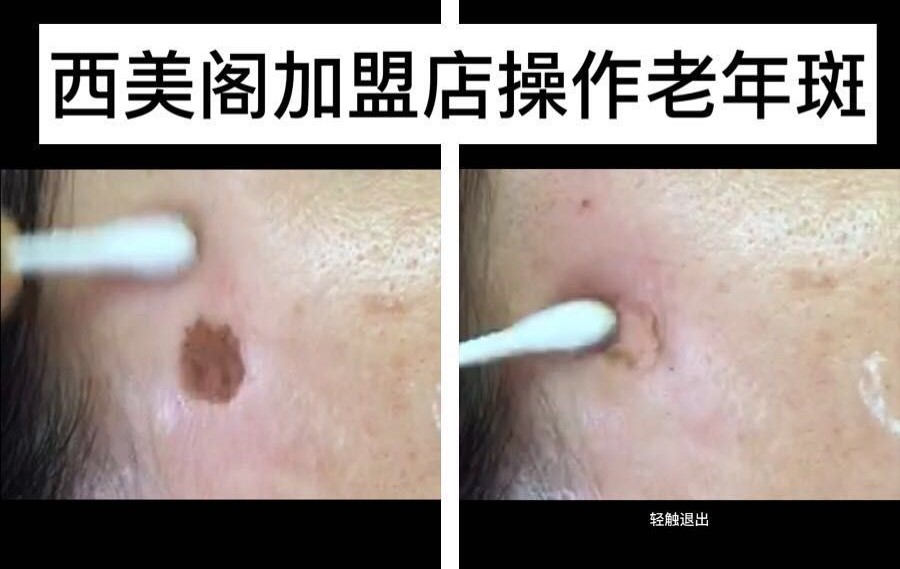 西美阁加盟店操作祛除老年斑