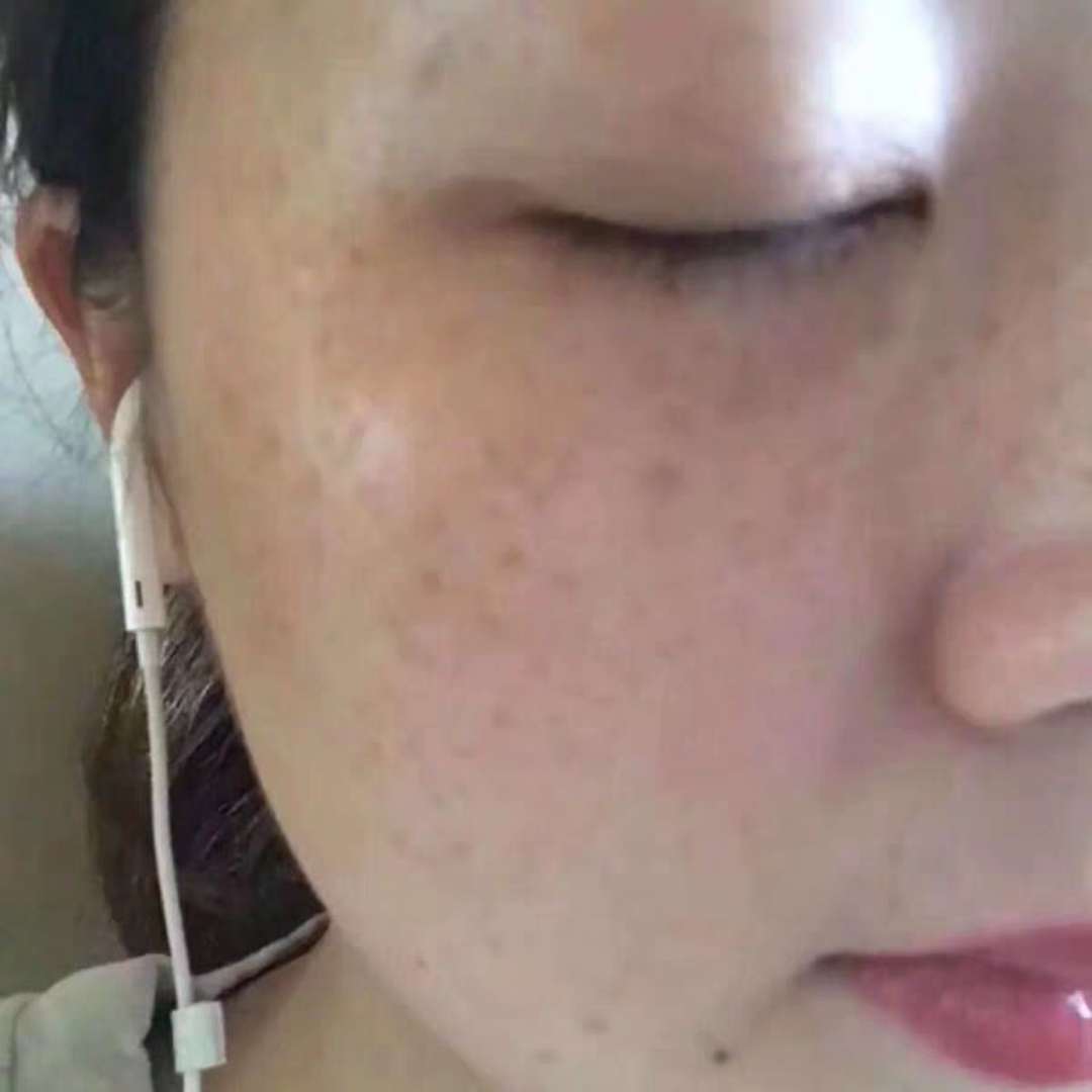 西美阁专利祛除老年斑当场干净