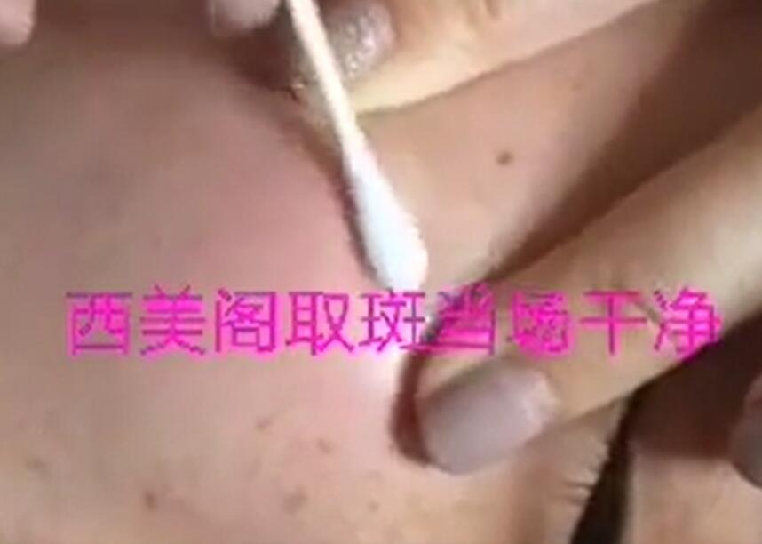 一擦即掉的老年斑过程视频演示